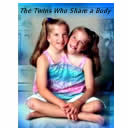 The Twins Who Share a Body